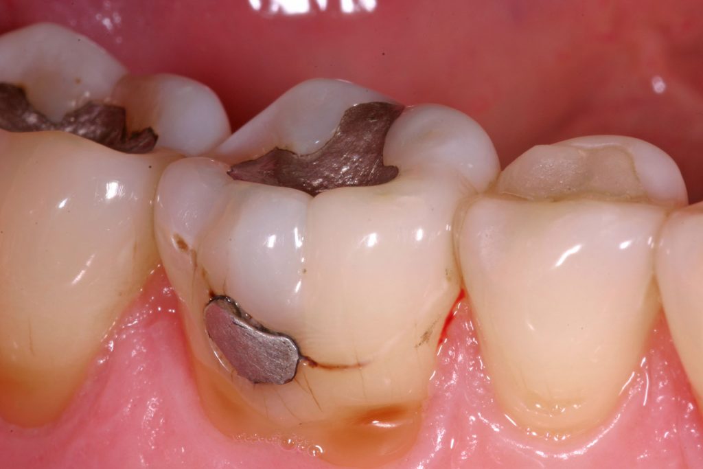 Zahnerhaltung – Praxis für Zahnheilkunde Melerski und Strauss